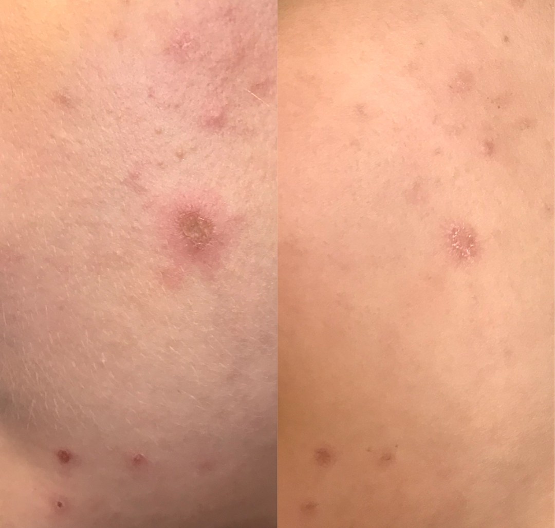 V létě se jakékoliv pleťové zákroky nedoporučují, nicméně akné, vyrážky apod. to ani v těchto měsících bohužel nevzdávají. Naše pacientky jsou ale důkazem, že pokud vás má na starost zkušený lékař, výsledky se dostaví již během 2 dnů a nemusíte svou pleť skrývat celé léto. Fotky jsou bez jakýchkoliv úprav.