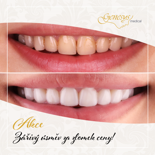 AKCE: zářivý úsměv za zlomek ceny!